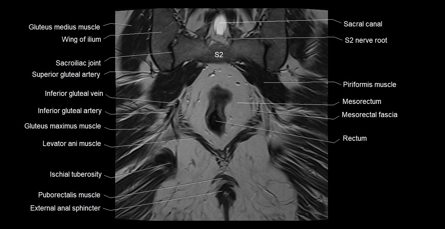 MRI coronal cross sectional anatomy male pelvis image 33.webp